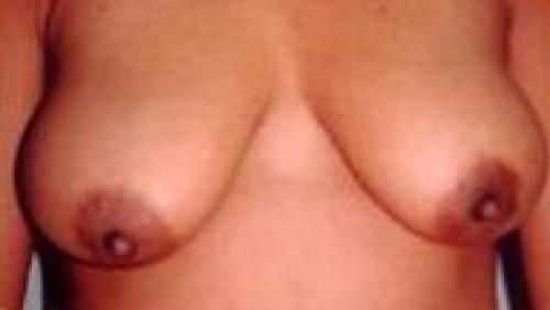 Before Image: Breast Lift - front