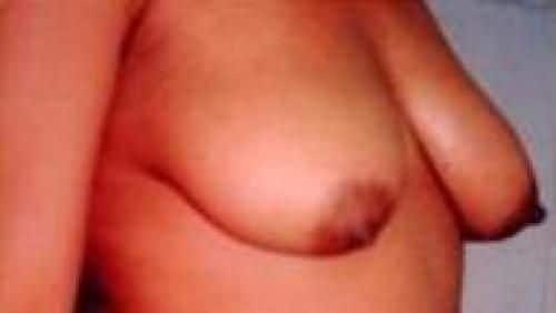 Before Image: Breast Lift - right-front-oblique