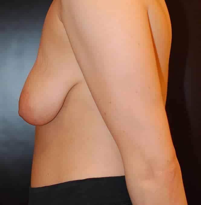 Before Image: Breast Lift - left-side