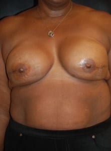 After Image: Breast Reconstruction - front