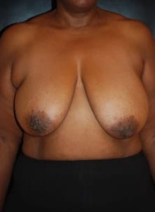 Before Image: Breast Reconstruction - front