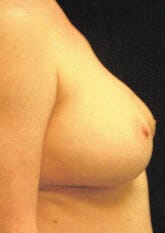 After Image: Breast Reconstruction - right-side
