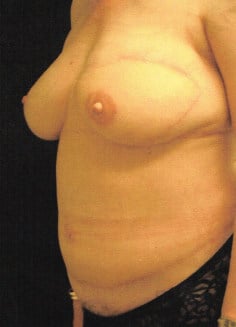 After Image: Breast Reconstruction - left-front-oblique