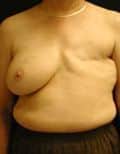 Before Image: Breast Reconstruction - front