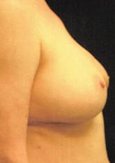 Before Image: Breast Reconstruction - right-side