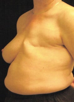 Before Image: Breast Reconstruction - left-front-oblique