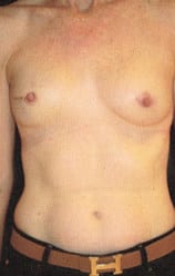 After Image: Breast Reconstruction - front