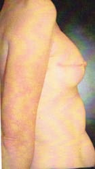 After Image: Breast Reconstruction - right-side