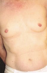 Before Image: Breast Reconstruction - front