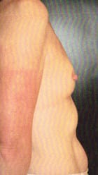 Before Image: Breast Reconstruction - right-side