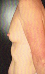 Before Image: Breast Reconstruction - left-side