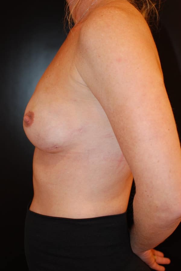 After Image: Breast Reconstruction - left-side