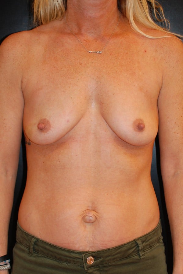 Before Image: Breast Reconstruction - front