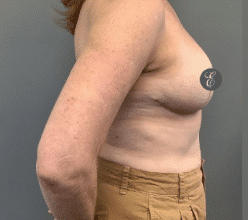 After Image: Breast Reduction - right-side
