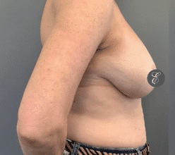 Before Image: Breast Reduction - right-side