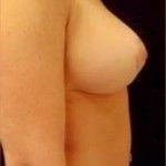 After Image: Breast Reduction - right-side