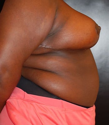 After Image: Breast Reduction - right-side