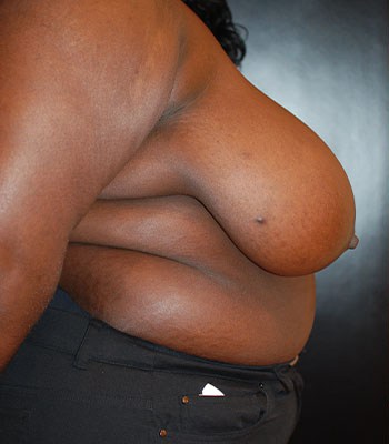 Before Image: Breast Reduction - right-side