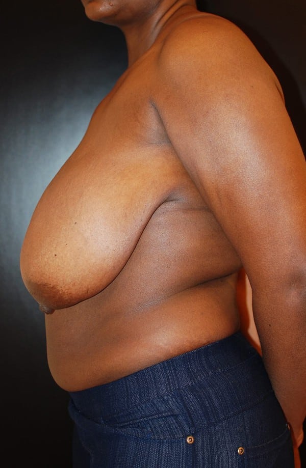Before Image: Breast Reduction - left-side