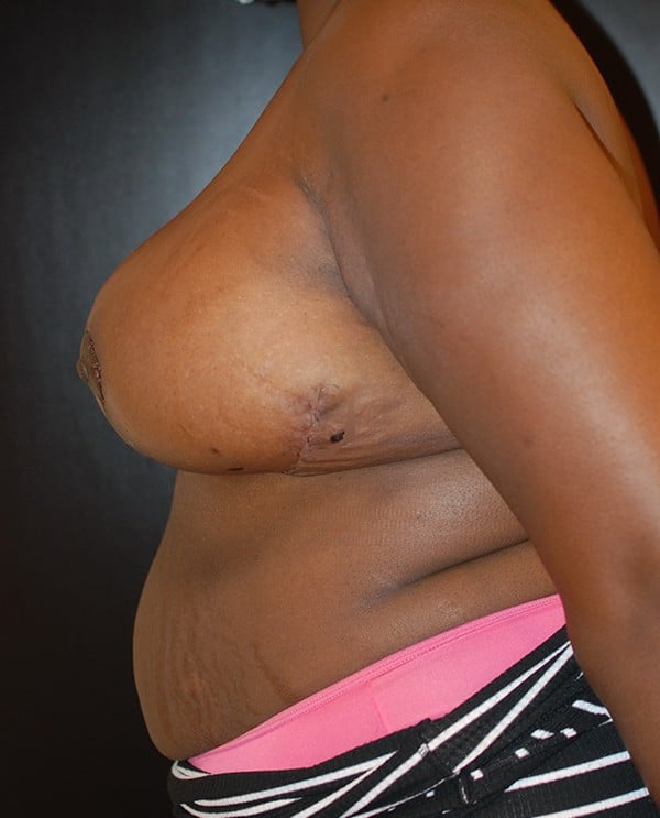 After Image: Breast Reduction - left-side