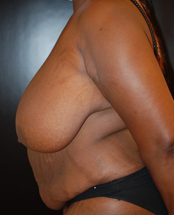 Before Image: Breast Reduction - left-side