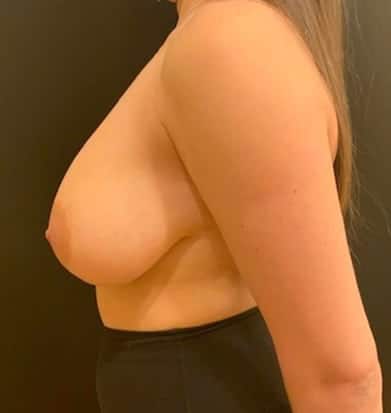 Before Image: Breast Reduction - left-side