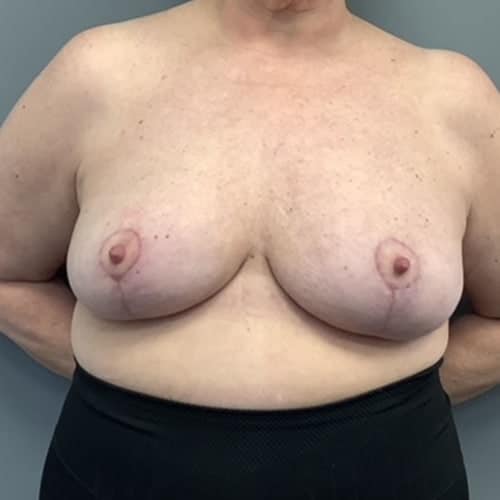 After Image: Breast Reduction - front