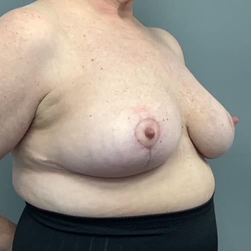 After Image: Breast Reduction - right-front-oblique