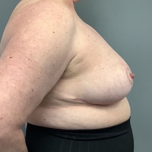 After Image: Breast Reduction - right-side
