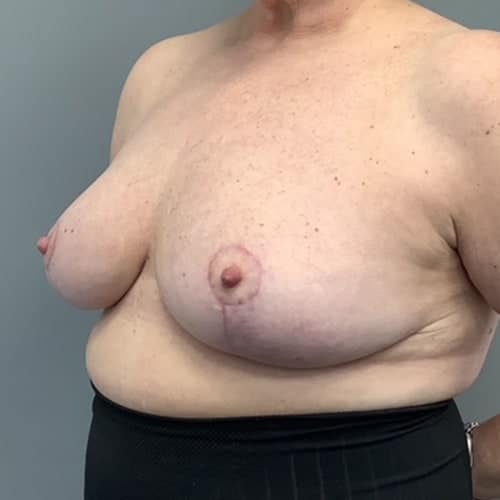 After Image: Breast Reduction - left-front-oblique