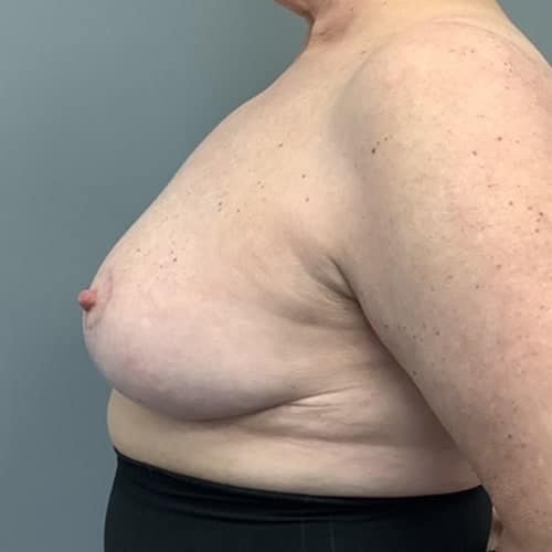After Image: Breast Reduction - left-side