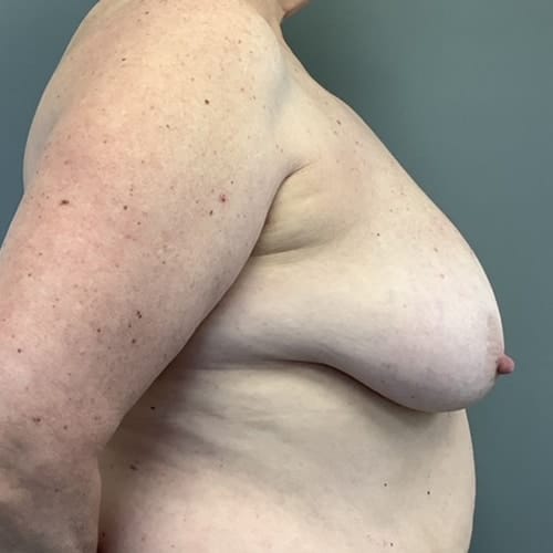Before Image: Breast Reduction - right-side