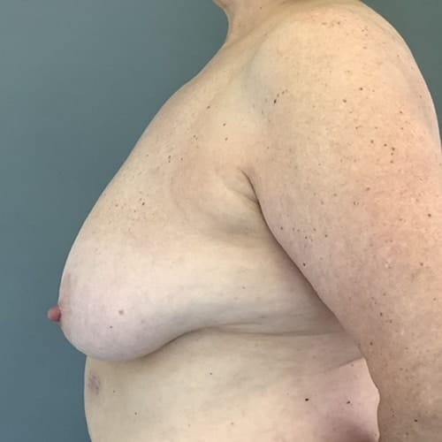 Before Image: Breast Reduction - left-side