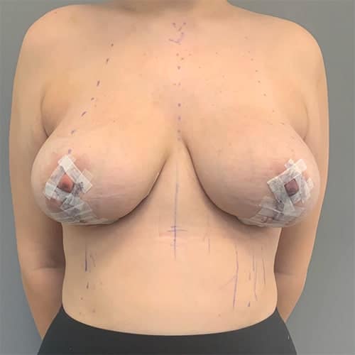 After Image: Breast Reduction - front
