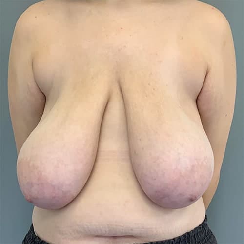 Before Image: Breast Reduction - front