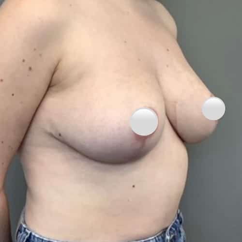 After Image: Breast Reduction - right-front-oblique