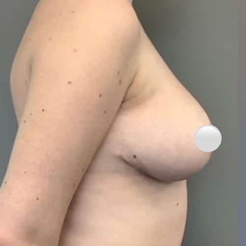 After Image: Breast Reduction - right-side