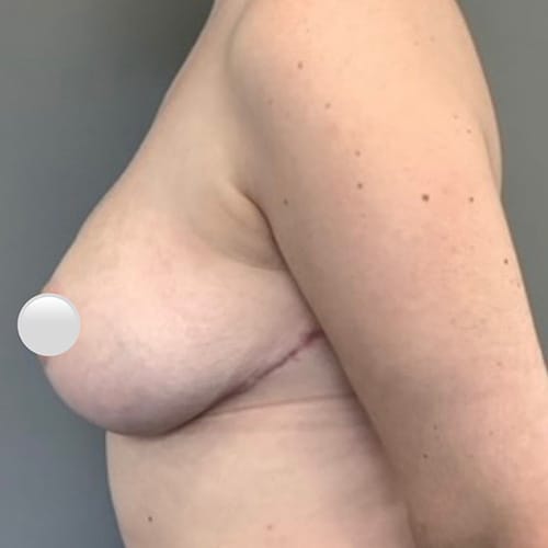 After Image: Breast Reduction - left-side