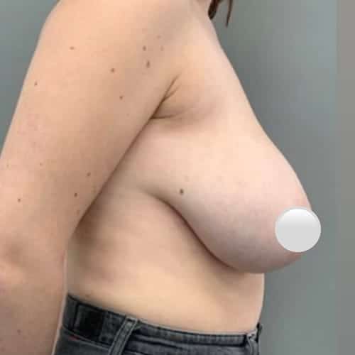 Before Image: Breast Reduction - right-side