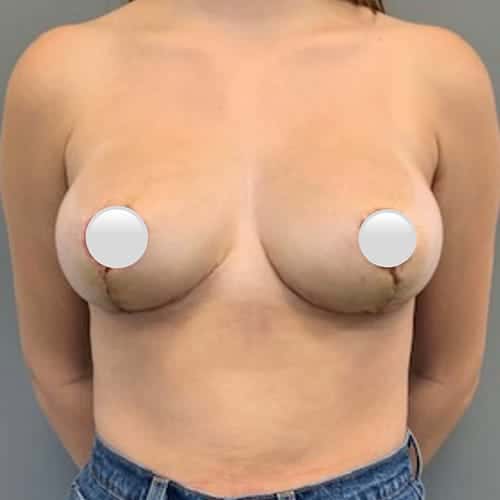After Image: Breast Reduction - front