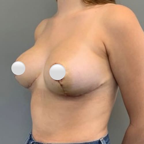After Image: Breast Reduction - left-front-oblique