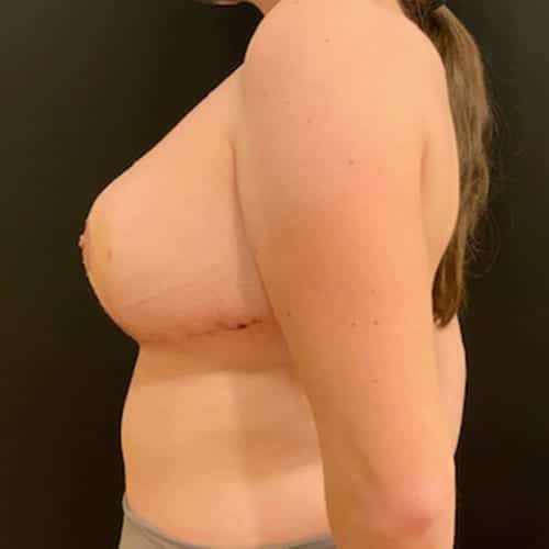 After Image: Breast Reduction - left-side
