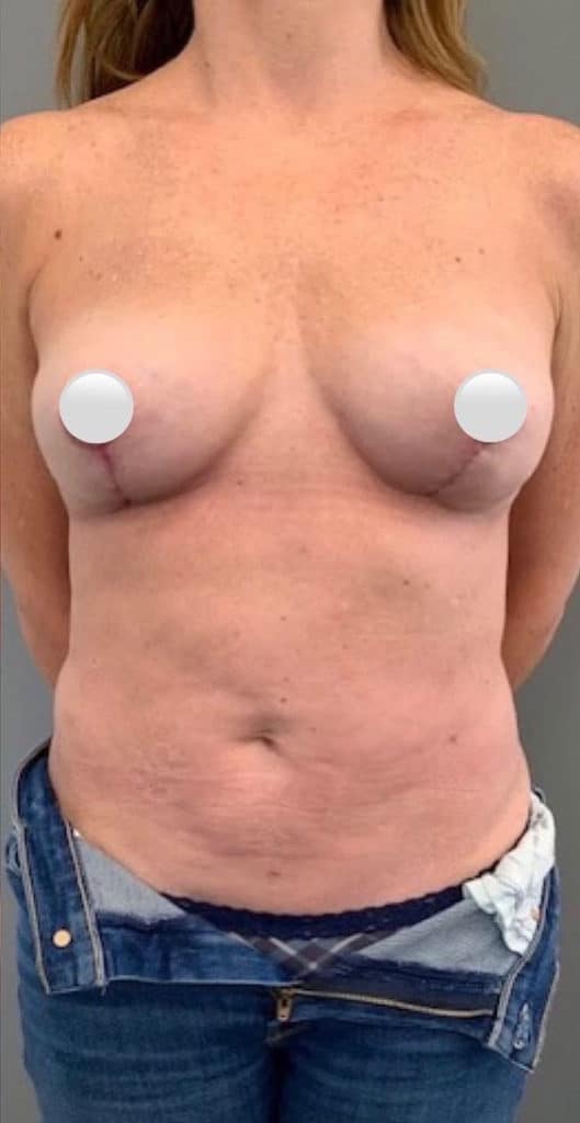 After Image: Breast Revision / Capsular Contracture - front
