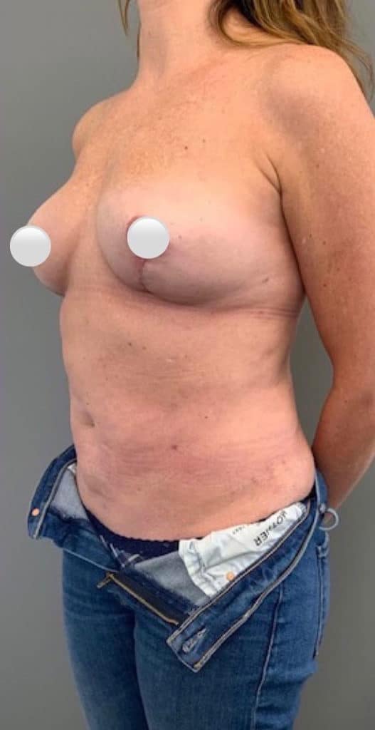 After Image: Breast Revision / Capsular Contracture - left-front-oblique