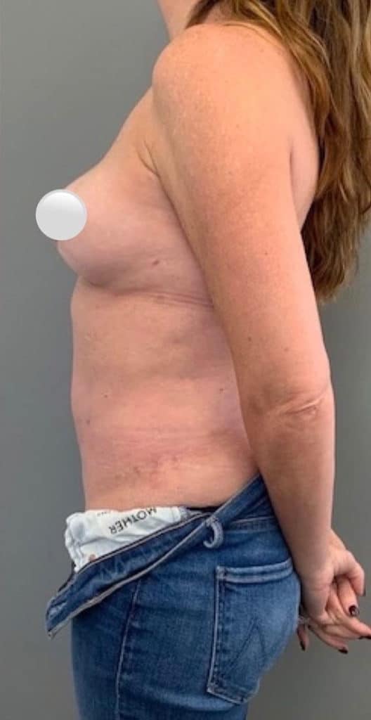 After Image: Breast Revision / Capsular Contracture - left-side