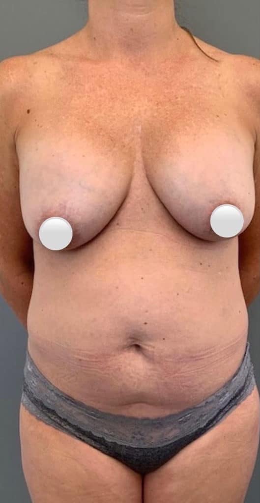 Before Image: Breast Revision / Capsular Contracture - front