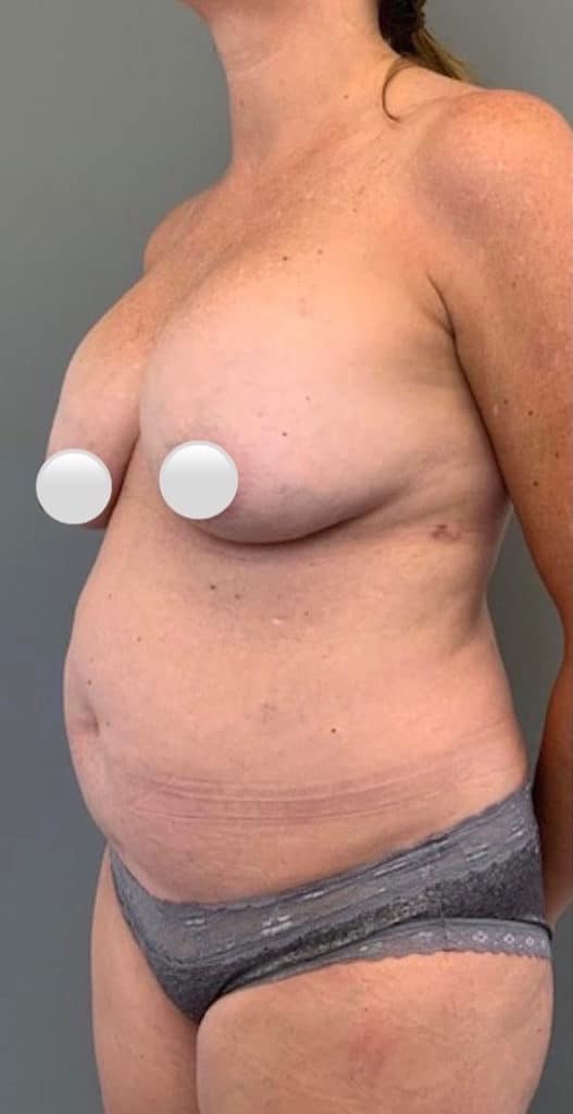 Before Image: Breast Revision / Capsular Contracture - left-front-oblique