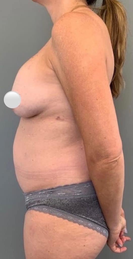 Before Image: Breast Revision / Capsular Contracture - left-side