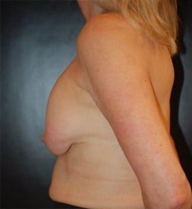 Before Image: Breast Revision / Capsular Contracture - left-side