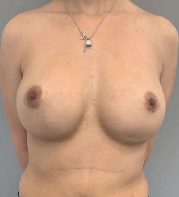 After Image: Breast Revision / Capsular Contracture - front